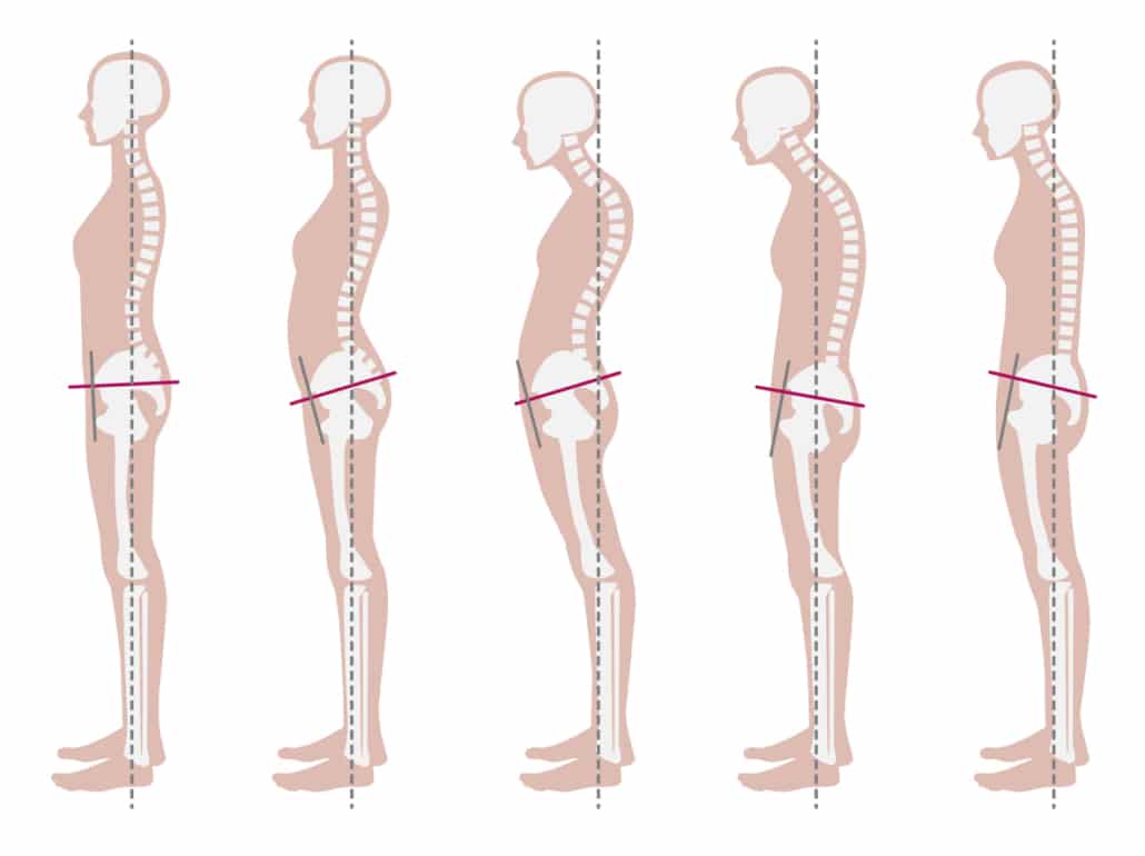 Skeletal sample of good and bad posture posture